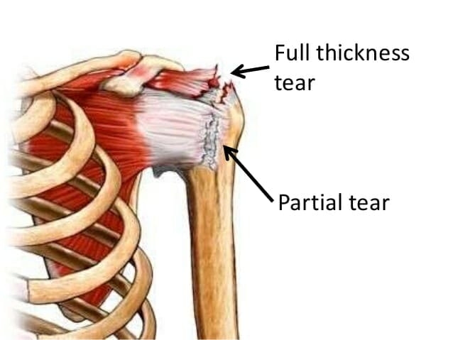 Partial rotator cuff clearance tear treatment